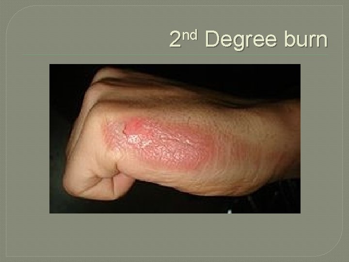 2 nd Degree burn 