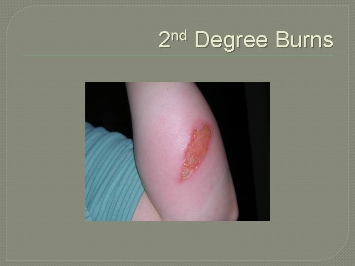 2 nd Degree Burns 