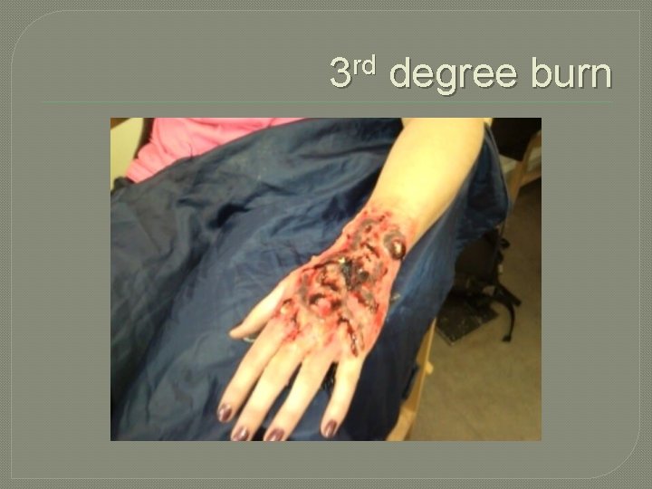 3 rd degree burn 