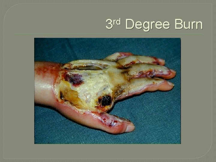3 rd Degree Burn 
