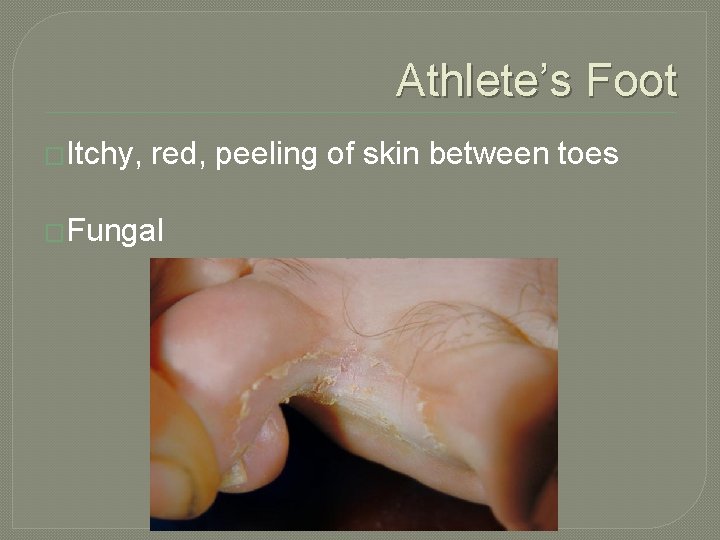 Athlete’s Foot �Itchy, red, peeling of skin between toes �Fungal 
