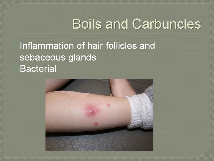 Boils and Carbuncles �Inflammation of hair follicles and sebaceous glands �Bacterial 
