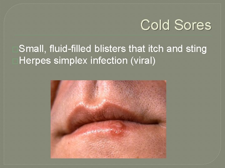 Cold Sores �Small, fluid-filled blisters that itch and sting �Herpes simplex infection (viral) 