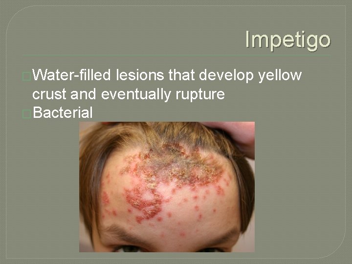 Impetigo �Water-filled lesions that develop yellow crust and eventually rupture �Bacterial 
