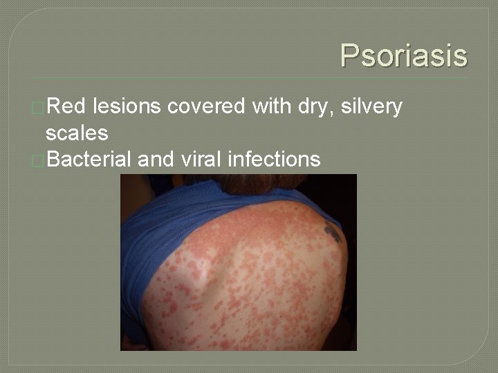 Psoriasis �Red lesions covered with dry, silvery scales �Bacterial and viral infections 