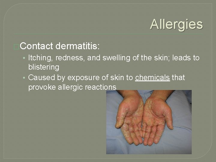 Allergies �Contact dermatitis: • Itching, redness, and swelling of the skin; leads to blistering