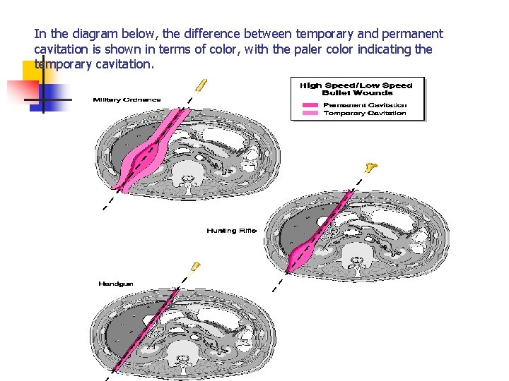 In the diagram below, the difference between temporary and permanent cavitation is shown in