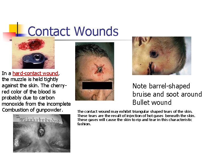 Contact Wounds In a hard-contact wound, the muzzle is held tightly against the skin.