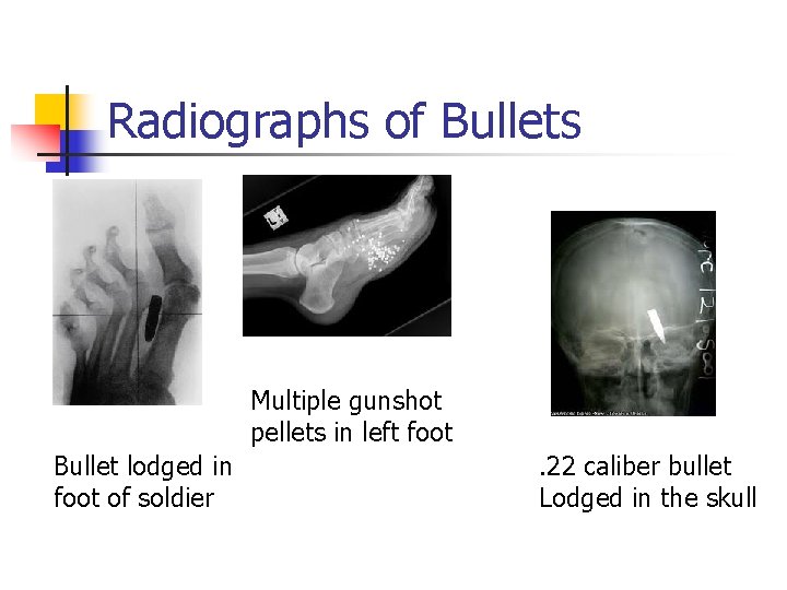 Radiographs of Bullets Multiple gunshot pellets in left foot Bullet lodged in foot of