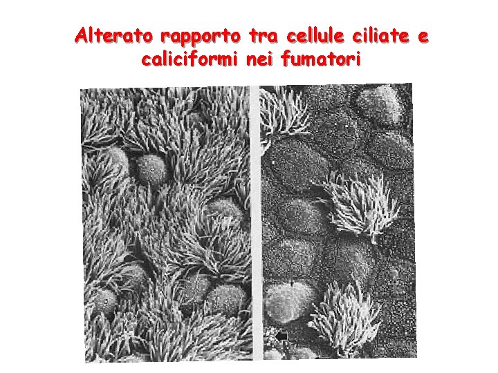 Alterato rapporto tra cellule ciliate e caliciformi nei fumatori 
