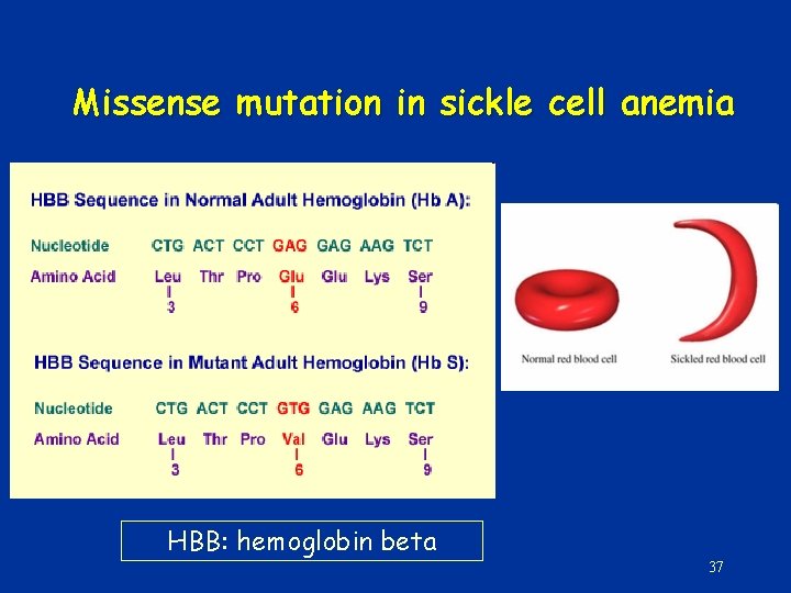 Missense mutation in sickle cell anemia HBB: hemoglobin beta 37 