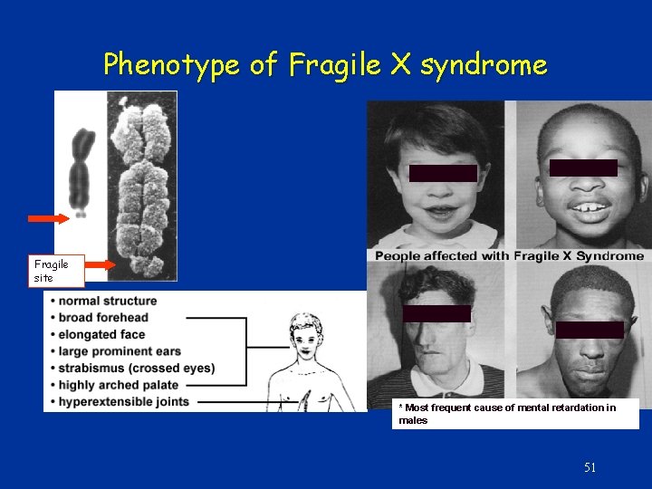 Phenotype of Fragile X syndrome Fragile site * Most frequent cause of mental retardation