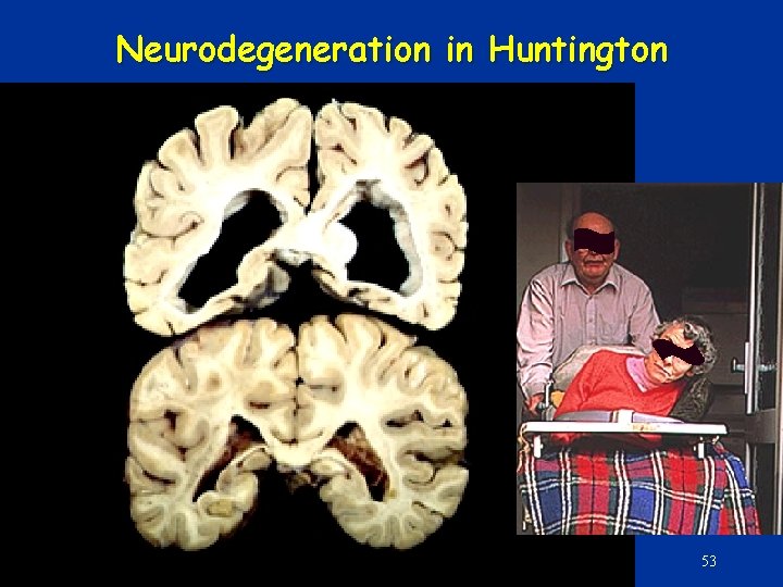Neurodegeneration in Huntington 53 