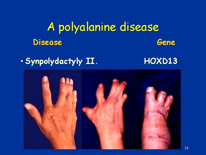 A polyalanine disease Disease • Synpolydactyly II. Gene HOXD 13 54 