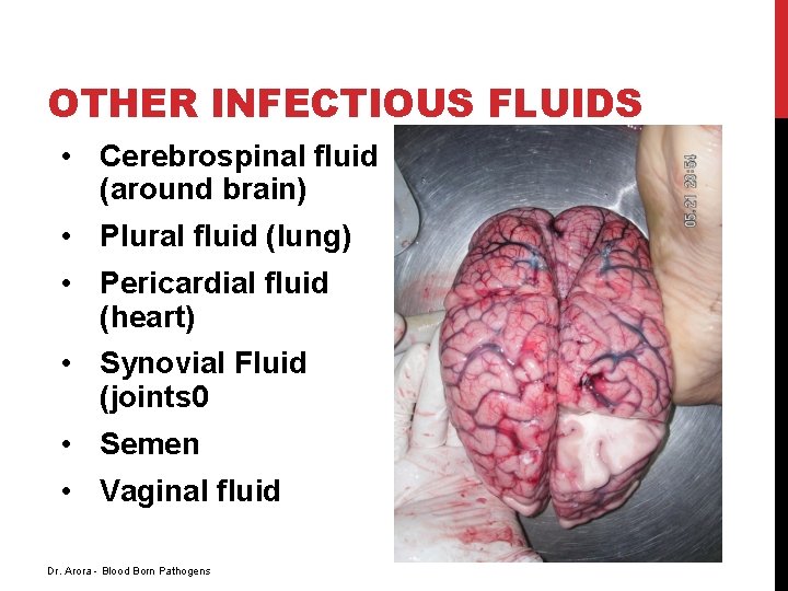 OTHER INFECTIOUS FLUIDS • Cerebrospinal fluid (around brain) • Plural fluid (lung) • Pericardial