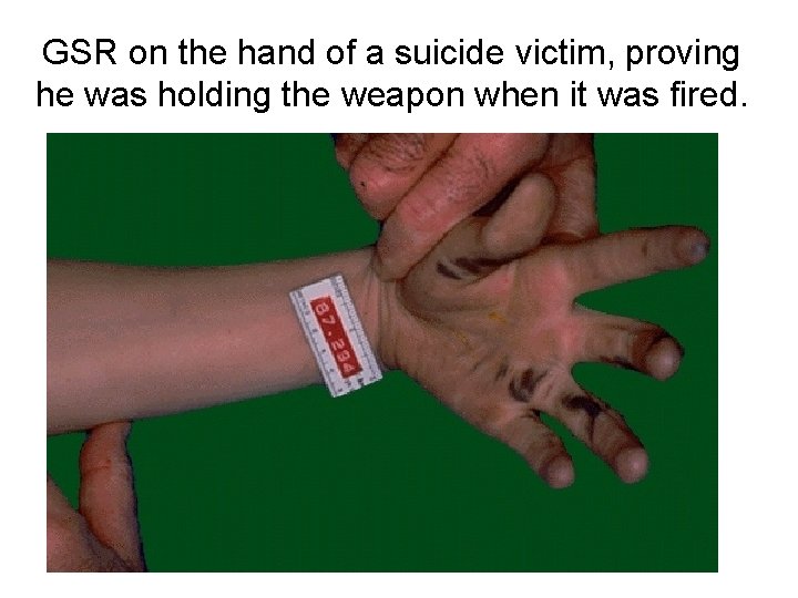 GSR on the hand of a suicide victim, proving he was holding the weapon GSR on the hand of a suicide victim, proving he was holding the weapon
