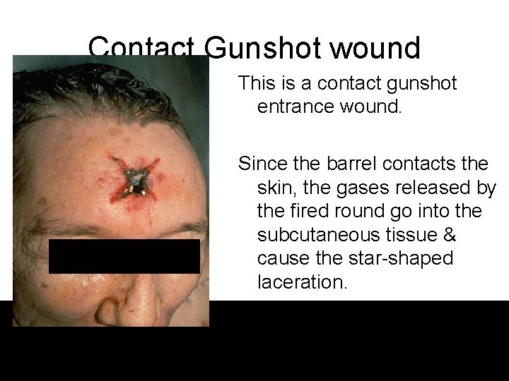 Contact Gunshot wound This is a contact gunshot entrance wound. Since the barrel contacts Contact Gunshot wound This is a contact gunshot entrance wound. Since the barrel contacts