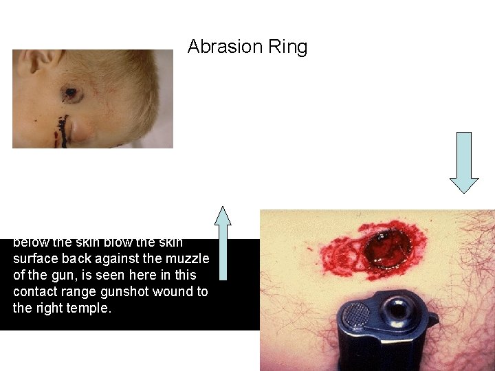 Abrasion Ring The abrasion ring, and a very clear muzzle imprint, are seen in Abrasion Ring The abrasion ring, and a very clear muzzle imprint, are seen in