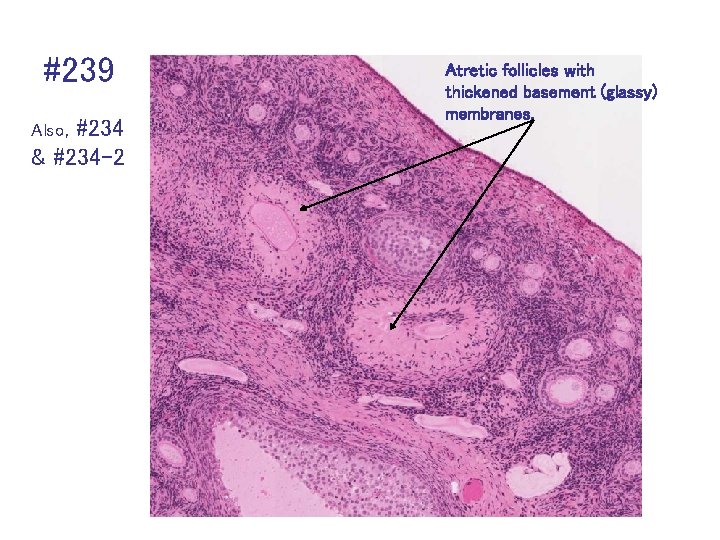 #239 Also, #234 & #234 -2 Atretic follicles with thickened basement (glassy) membranes. 
