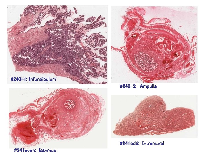#240 -1: Infundibulum #240 -2: Ampulla #241 odd: Intramural #241 even: Isthmus 