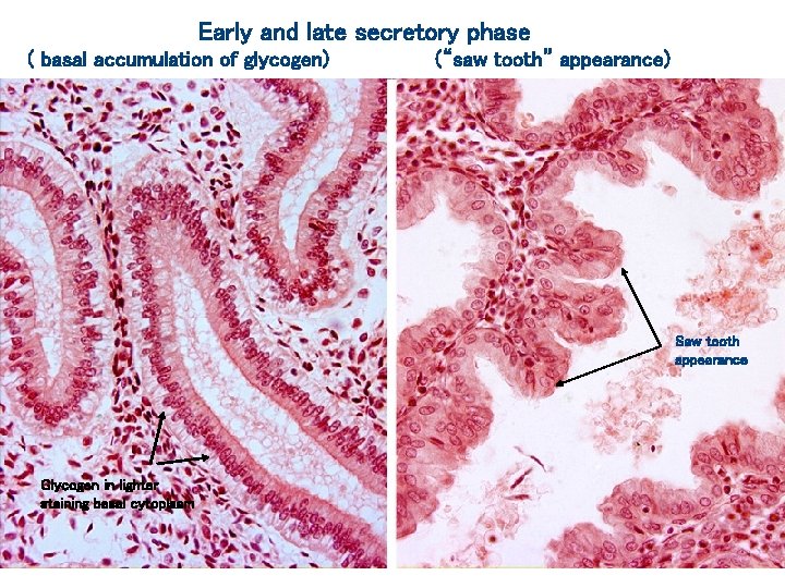 Early and late secretory phase ( basal accumulation of glycogen) (“saw tooth” appearance) Saw