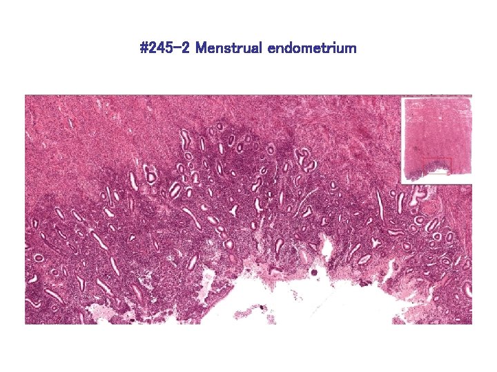 #245 -2 Menstrual endometrium 