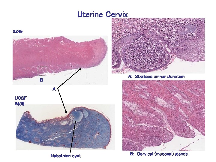 Uterine Cervix #249 A: Stratocolumnar Junction B A UCSF #405 Nabothian cyst B: Cervical