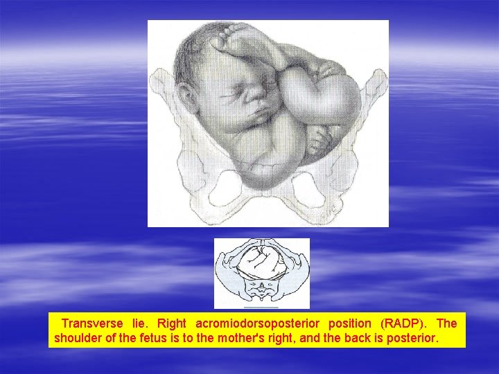Transverse lie. Right acromiodorsoposterior position (RADP). The shoulder of the fetus is to the Transverse lie. Right acromiodorsoposterior position (RADP). The shoulder of the fetus is to the
