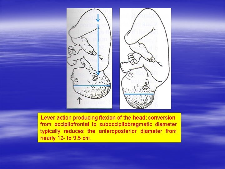 Lever action producing ftexion of the head; conversion from occipitofrontal to suboccipitobregmatic diameter typically Lever action producing ftexion of the head; conversion from occipitofrontal to suboccipitobregmatic diameter typically