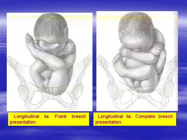 I I Longitudinal presentation. lie. Frank breech Longitudinal lie. Complete breech presentation. I I Longitudinal presentation. lie. Frank breech Longitudinal lie. Complete breech presentation.