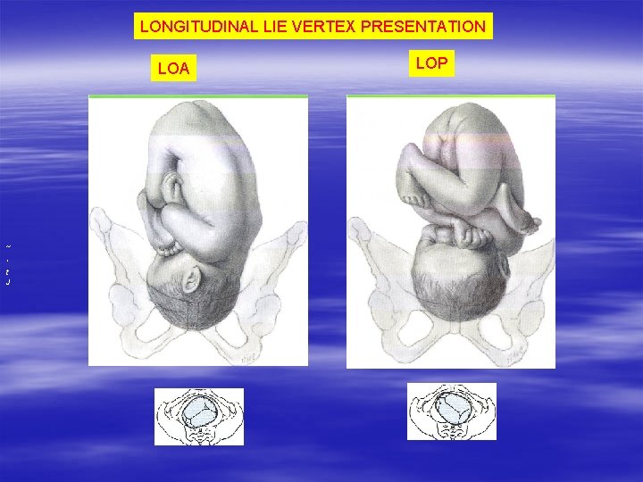 LONGITUDINAL LIE VERTEX PRESENTATION LOA ~ ' t J LOP LONGITUDINAL LIE VERTEX PRESENTATION LOA ~ ' t J LOP