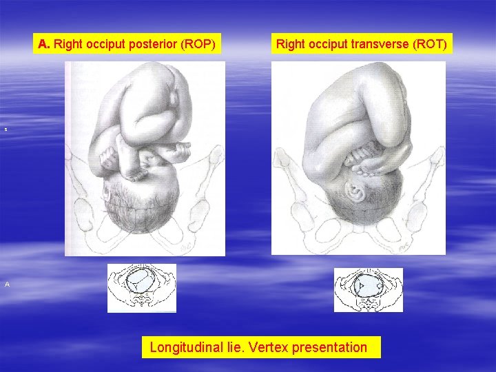 A. Right occiput posterior (ROP) Right occiput transverse (ROT) s A Longitudinal lie. Vertex A. Right occiput posterior (ROP) Right occiput transverse (ROT) s A Longitudinal lie. Vertex