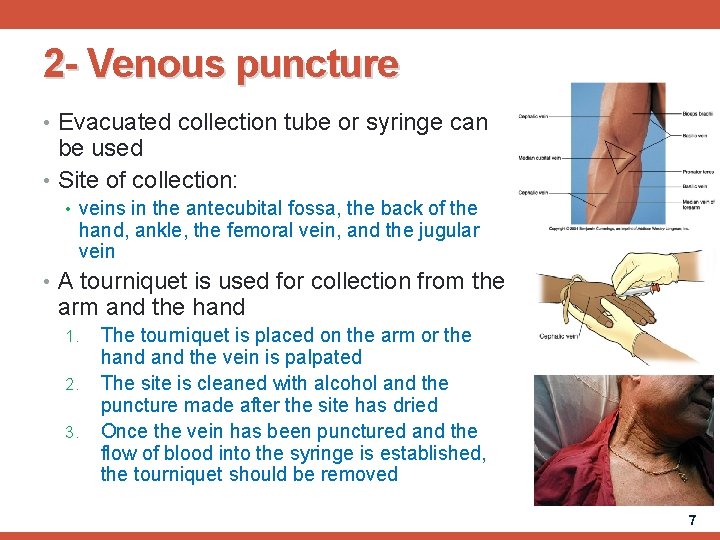 2 - Venous puncture • Evacuated collection tube or syringe can be used •