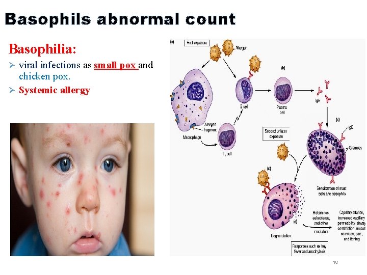 Basophils abnormal count Basophilia: Ø viral infections as small pox and chicken pox. Ø