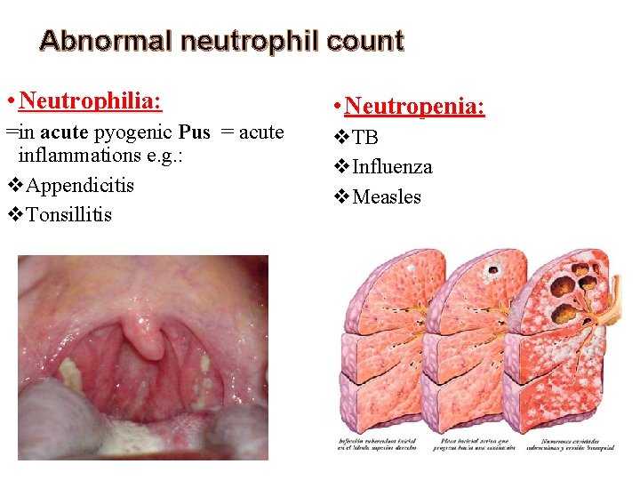 Abnormal neutrophil count • Neutrophilia: • Neutropenia: =in acute pyogenic Pus = acute inflammations