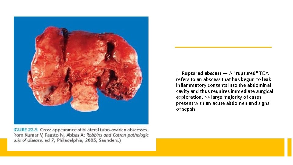  • Ruptured abscess — A "ruptured" TOA refers to an abscess that has