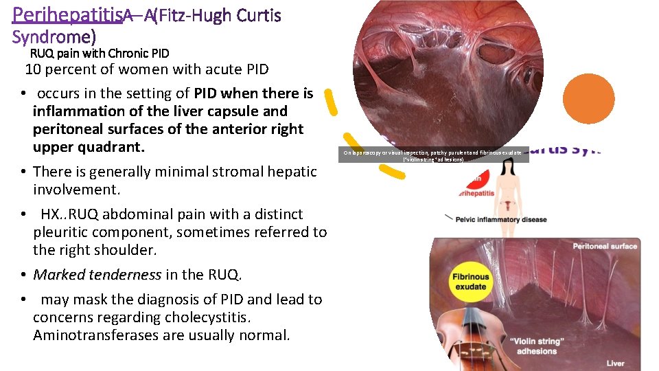 RUQ pain with Chronic PID 10 percent of women with acute PID • occurs
