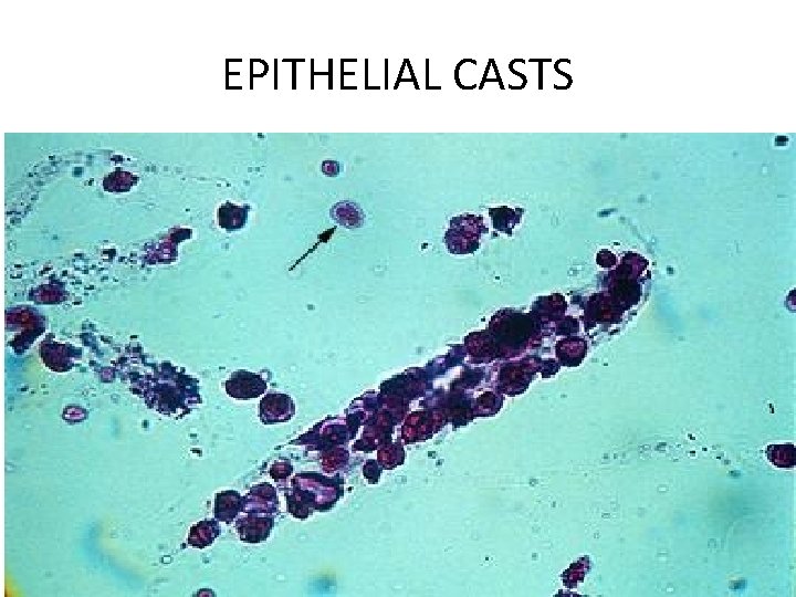 EPITHELIAL CASTS 