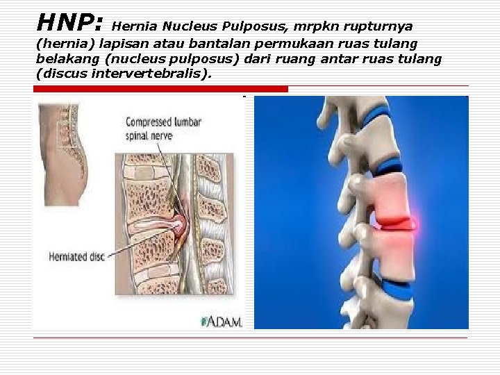 HNP: Hernia Nucleus Pulposus, mrpkn rupturnya (hernia) lapisan atau bantalan permukaan ruas tulang belakang