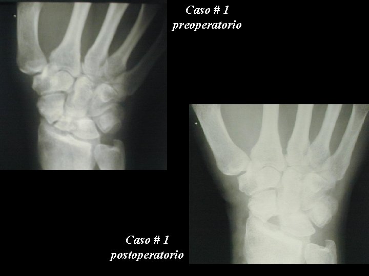 Caso # 1 preoperatorio Caso # 1 postoperatorio 