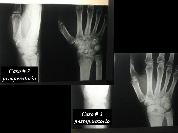 Caso # 3 preoperatorio Caso # 3 postoperatorio 