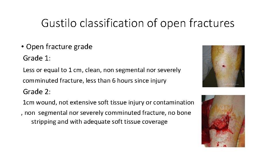 Gustilo classification of open fractures • Open fracture grade Grade 1: Less or equal