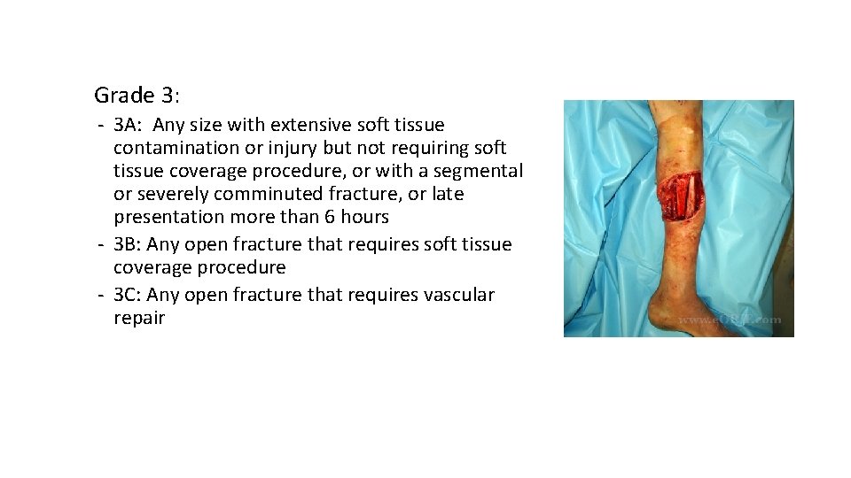 Grade 3: ‐ 3 A: Any size with extensive soft tissue contamination or injury