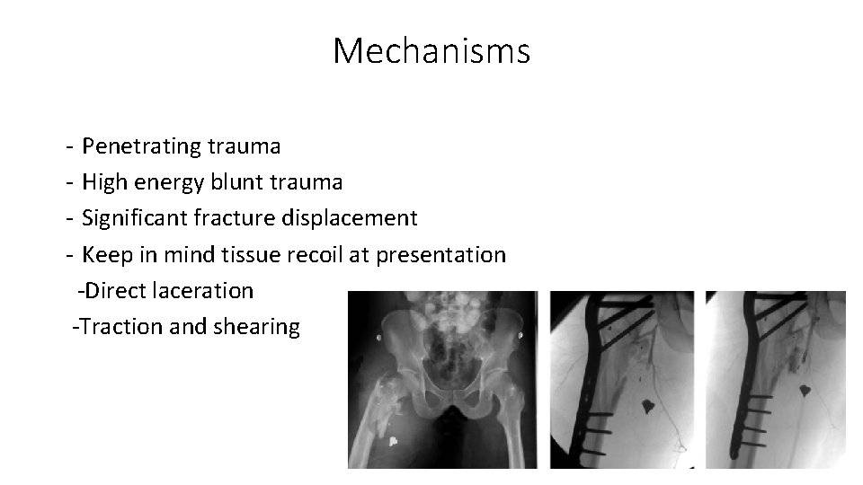 Mechanisms ‐ ‐ Penetrating trauma High energy blunt trauma Significant fracture displacement Keep in