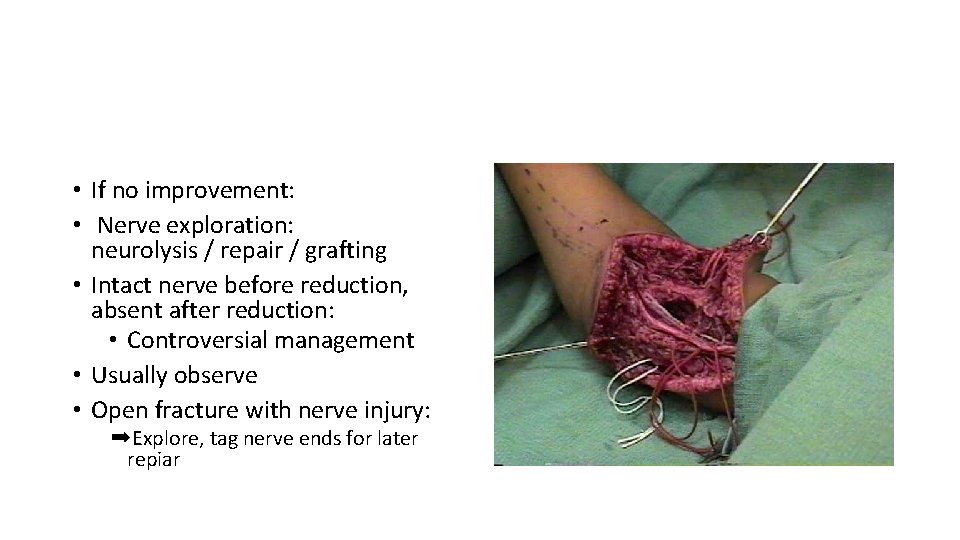  • If no improvement: • Nerve exploration: neurolysis / repair / grafting •