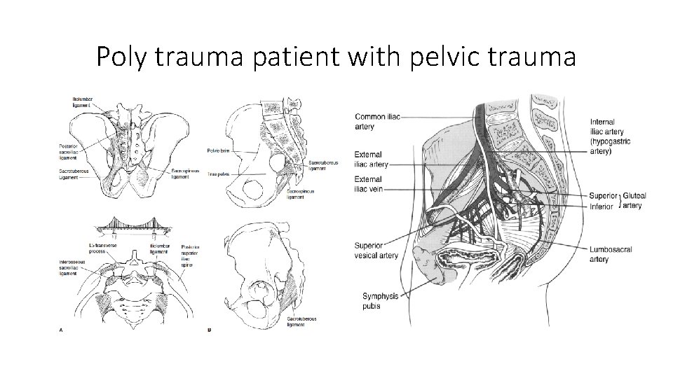 Poly trauma patient with pelvic trauma 