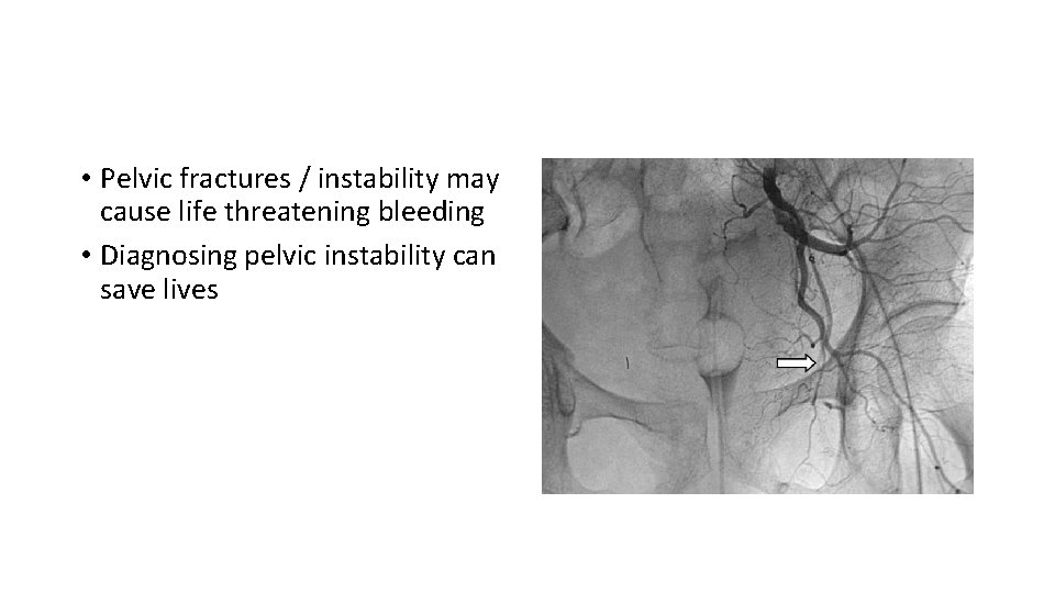  • Pelvic fractures / instability may cause life threatening bleeding • Diagnosing pelvic