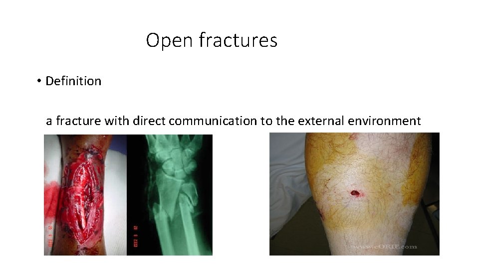 Open fractures • Definition a fracture with direct communication to the external environment 