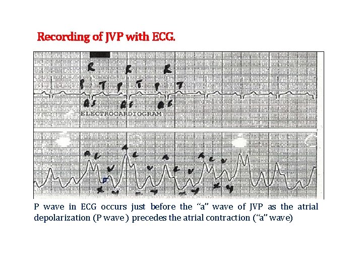 Recording of JVP with ECG. P wave in ECG occurs just before the “a”