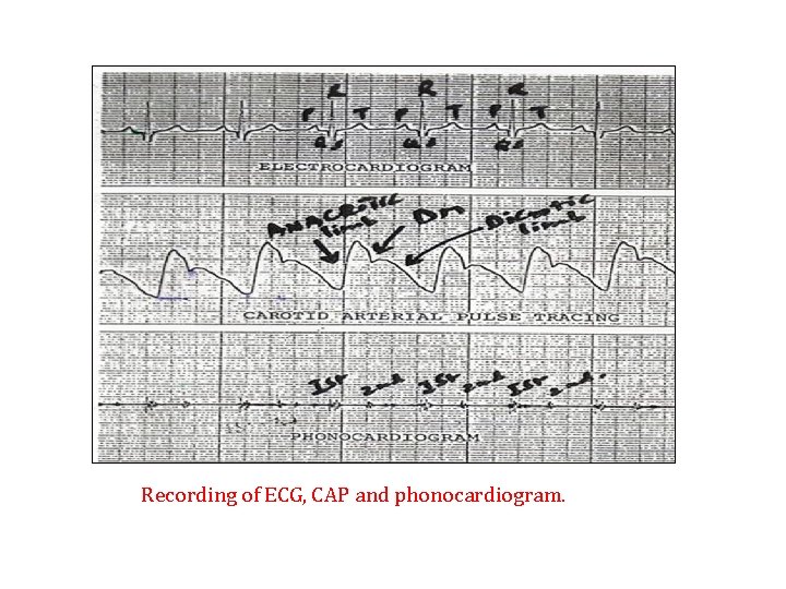 Recording of ECG, CAP and phonocardiogram. 